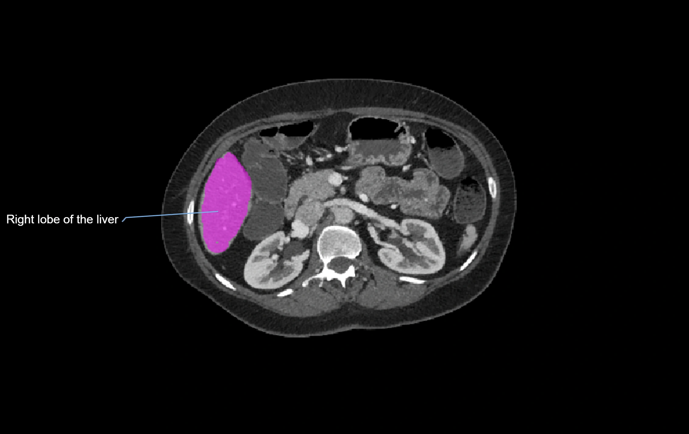 CT lliver lobes axial cross sectional anatomy labelled image -00026.webp